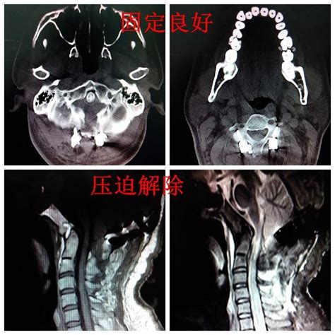 頭頂後方凹陷|顱底凹陷 